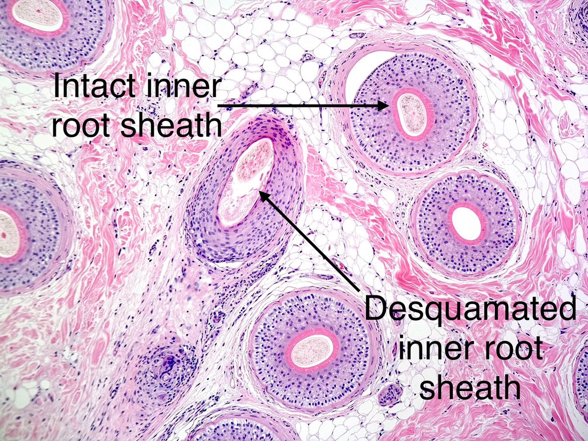 A beautiful example of the sine qua non for diagnosis of central centrifugal scarring #alopecia. Premature desquamation of the inner root sheath (in the s/c fat here). Rupture too. May be focal so keep those 👀 open😉
#pathology
#dermatology
💙