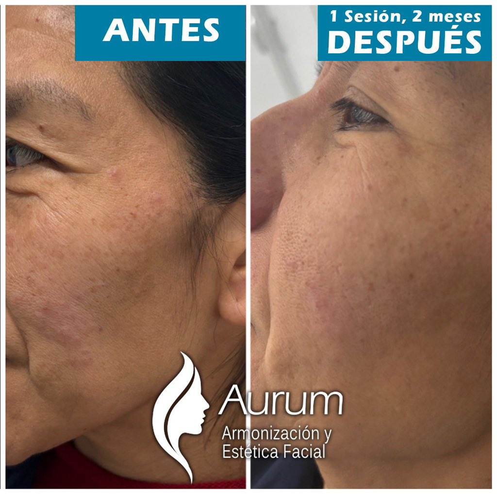 cuident1's tweet image. Rejuvenece tu piel desde la primera sesion. Colocación de #bioestimuladordecolageno #acidopolilactico resultados increíbles.