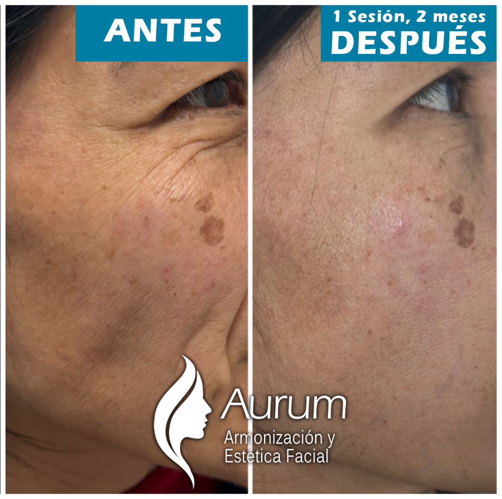 cuident1's tweet image. Rejuvenece tu piel desde la primera sesion. Colocación de #bioestimuladordecolageno #acidopolilactico resultados increíbles.