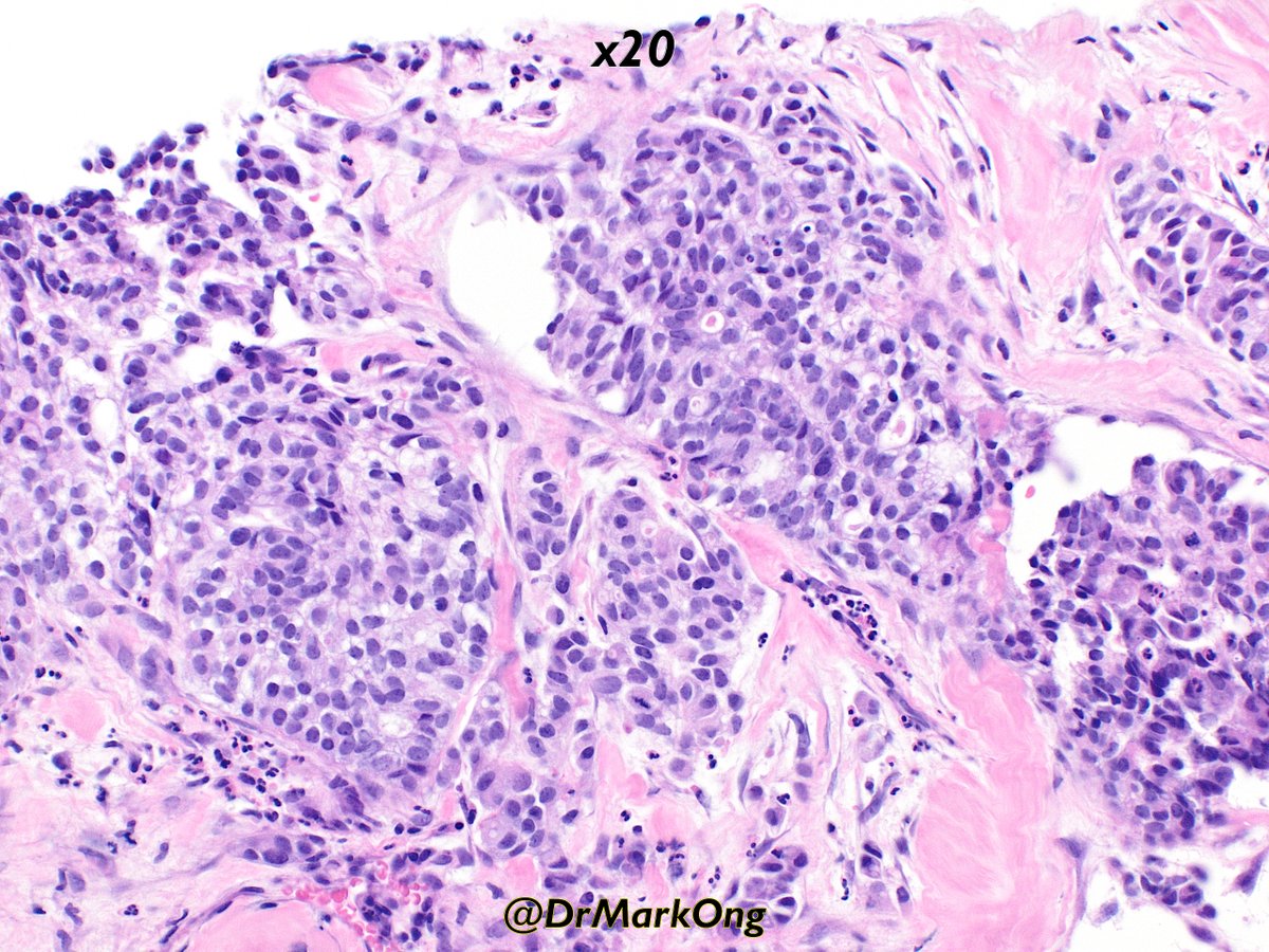 Core biopsy of inguinal lymph node from adult female.

What was the primary tumour?

#pathology #PathX