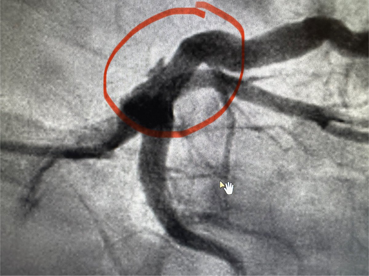 Umair2017's tweet image. Catheter-related intimal tear/focal dissection at proximal LAD in a 50 year old male, during this pre-AVR elective diagnostic cath. Angio + #IVUS below 👇

♦️How would you manage? 🤨 

#ACCFIT #CardioTwitter #Cardiology @SCAI @ACCinTouch #RadialFirst @BCMHeart @AkuCardiology