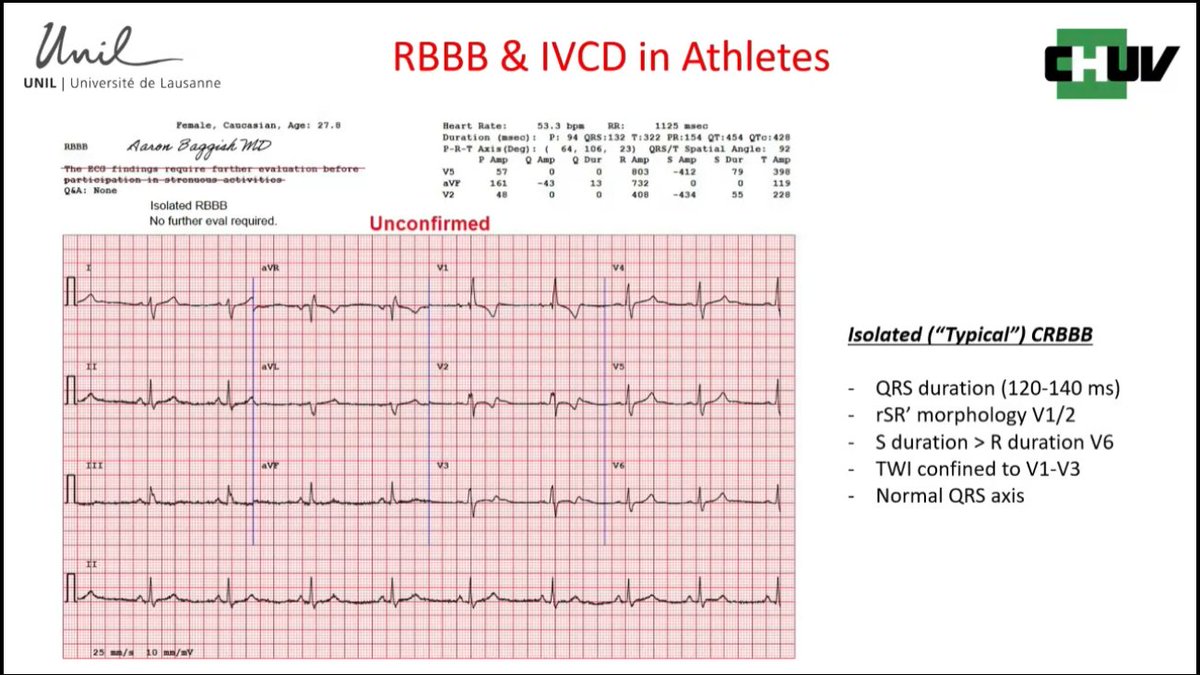 BJSM_BMJ's tweet image. Get ready for our next #IC25 session: the ECG ‘Potpourri’! 🌟 ecgsummit.org

Diving into topics including RBBB and IVCD in #athletes, interpreting borderline #ECG findings, ST segment depression, QRS fragmentation, juvenile TWI, anterior TWI in female athletes, and what