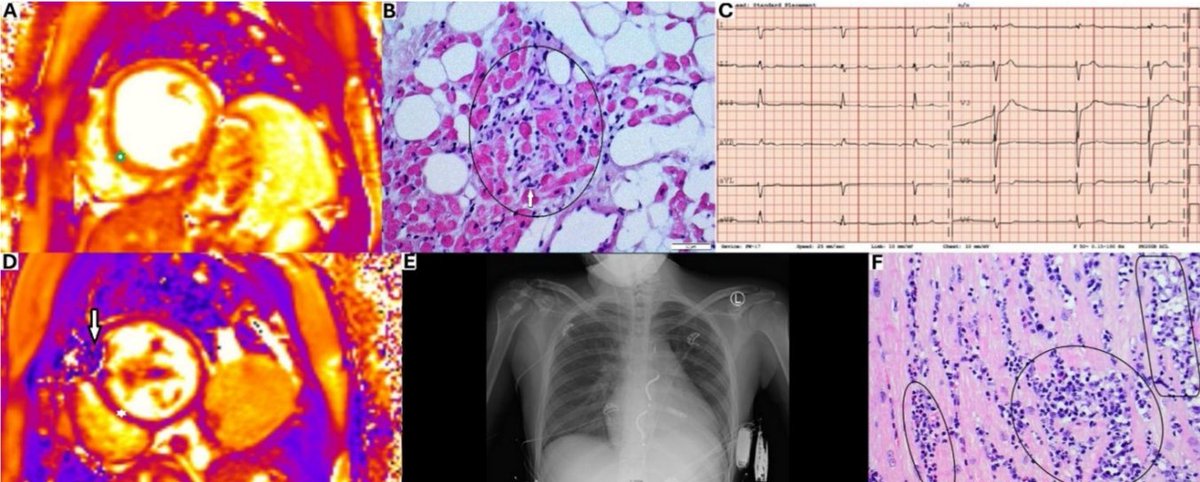 J_Malinowski73's tweet photo. From mononucleosis to heart transplantation: An uncommon course of Epstein–Barr
virus-associated myocarditis

Łukasz Nowotka et al.

https://t.co/9fi44zVQnR https://t.co/jFIqKghkJX