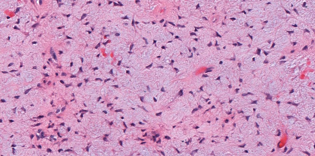 20 yo M w/ 5 cm lytic bone lesion in proximal tibia metaphysis, sharply demarcated w/ sclerotic rim. 
Answer ✅ youtu.be/LIY3jatGjv4?si…
Digital slide: kikoxp.com/posts/4606. 
#BSTpath #radpathmatch #radiology #pathology #pathTwitter #orthotwitter