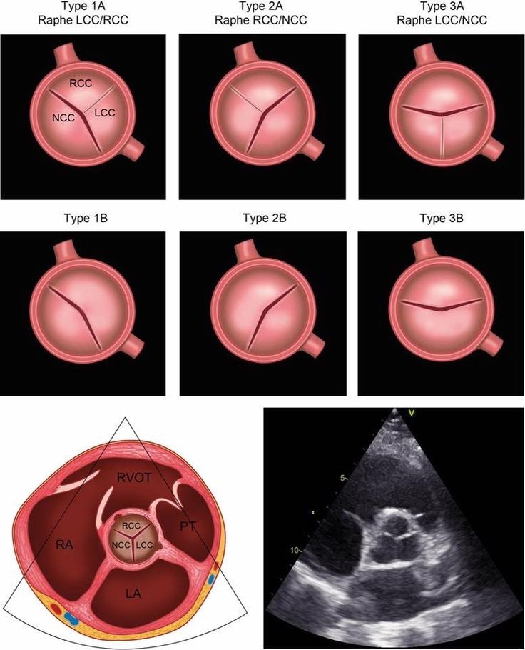 Bicuspid Aortic Valve (BAV) Summary Points

Bicuspid Aortic Valve (BAV) is a congenital condition with only 2 functional valve cusps instead of 3.

🔹 Type A (With Raphe)
▪︎Most common type (~70–85%)
▪︎Formed by fusion of two cusps (usually right and left coronary cusps)