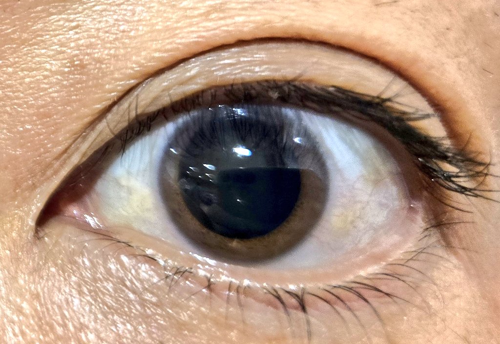 サンバカップル (@sambacp) on Twitter photo 今日は眼科🏥
眩し~い👁️👁️🗨️ 今日は眼科🏥
眩し~い👁️👁️🗨️