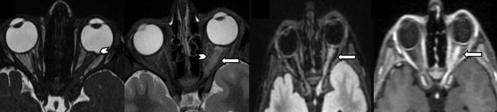 This week’s SPIN-POV: In a case of a pediatric ADEM, always look at the optic nerves. Optic disc swelling, protrusion, neuritis, and perineuritis with periorbital fat stranding and post-contrast enhancement are highly suggestive of MOGAD and can clinch the diagnosis.