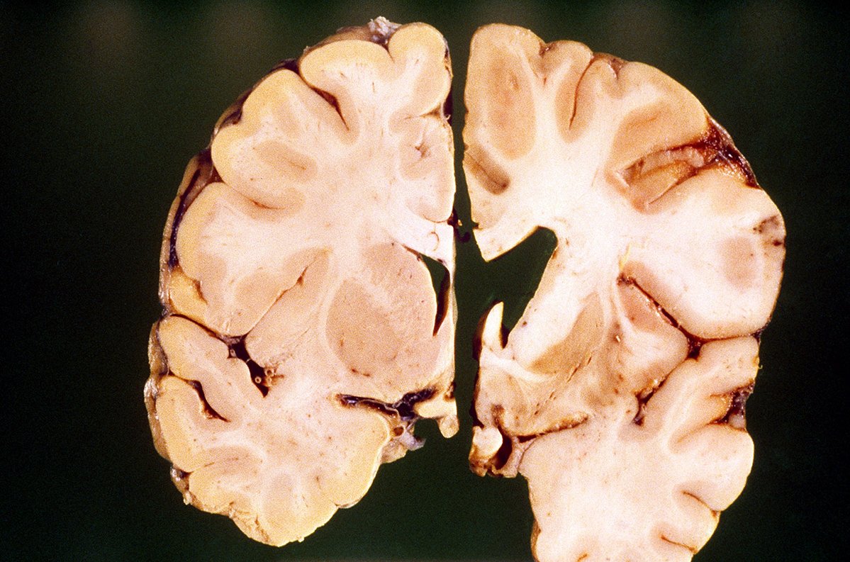 manuelacasasoli's tweet image. A great hope for patients with Huntington’s disease.

&quot;A gene therapy appears to be the first treatment to slow the progression of Huntington disease, an inherited, fatal neurological disorder […]&quot;.

#Science #Neuroscience #Brain #Health
⏯️In a first, a gene therapy seems to…