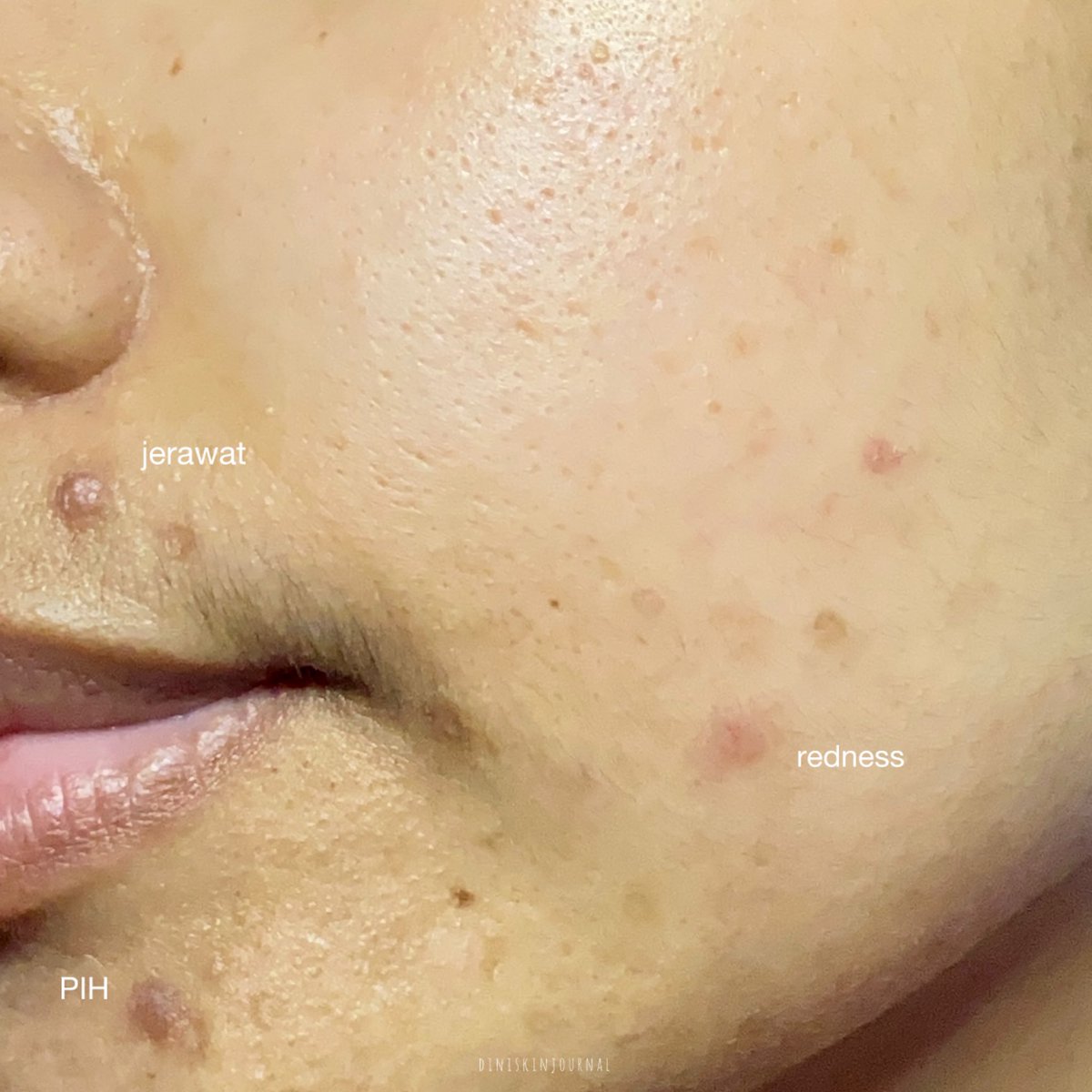 mamooong's tweet image. pas kondisi kulit lagi rewel biasanya aku back to minimalist skincare. cukup pakai moisturizer multifungsi yg mencangkup apa yg dibutuhin kulit. here’s are my recommendations! esp if you have oily acne prone skin 👀 

#SkincareRoutine #MoisturizerViral