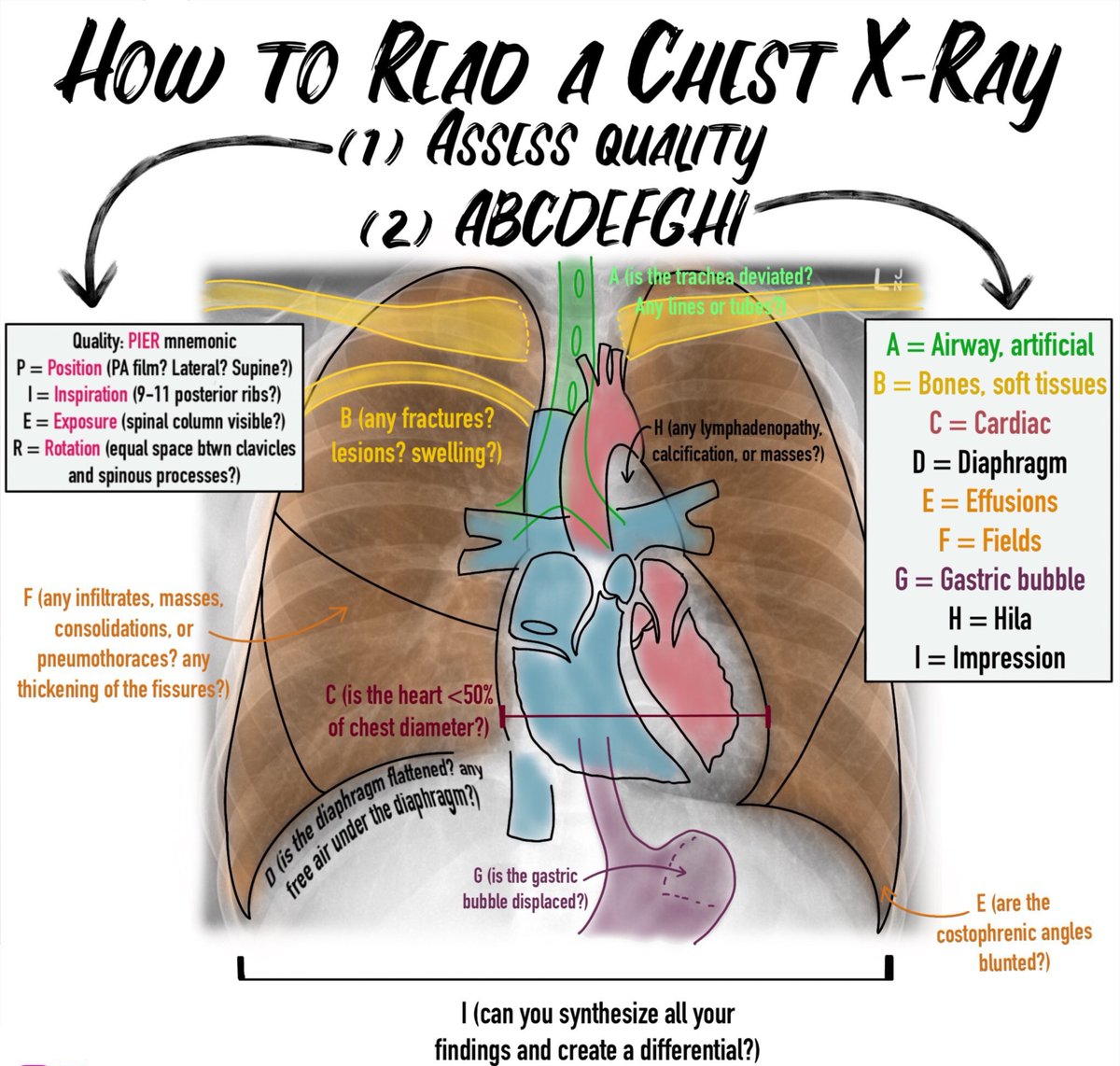 How to read a chest X-ray