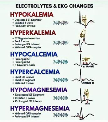 ECG tricks electrolytes imbalance