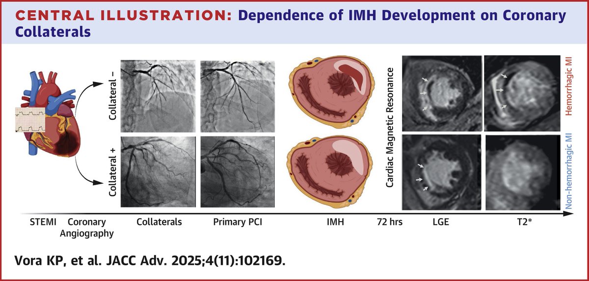 Hemorrhagic MI is why STEMI needs a pre-PCI checkpoint. Treat speed + wisdom: before PCI, hold the cine, watch collaterals, record Rentrop. A small pause that upgrades CCU triage, imaging, and follow-up. 

Rentrop in every Cath report of MI.
MIRON-CL Trial
sciencedirect.com/science/articl…