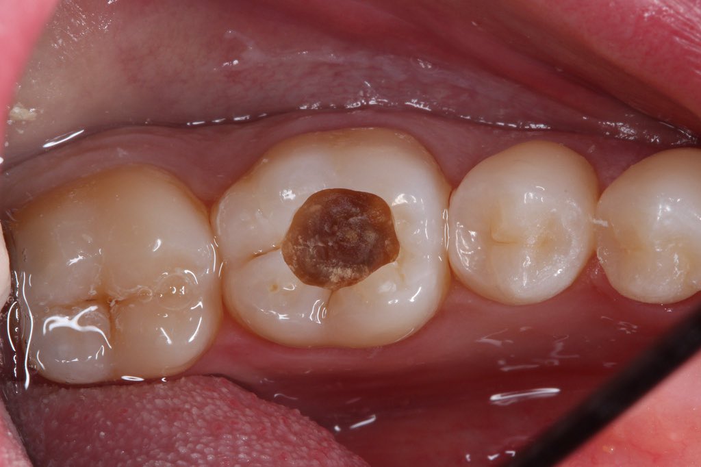 Dr_Pharouk's tweet image. Take a careful look at this picture of a tooth with a hole (cavity). What do you think is the most common cause of it  👀👀

The winner gets lunch from me.

Hint - 3 or more words.