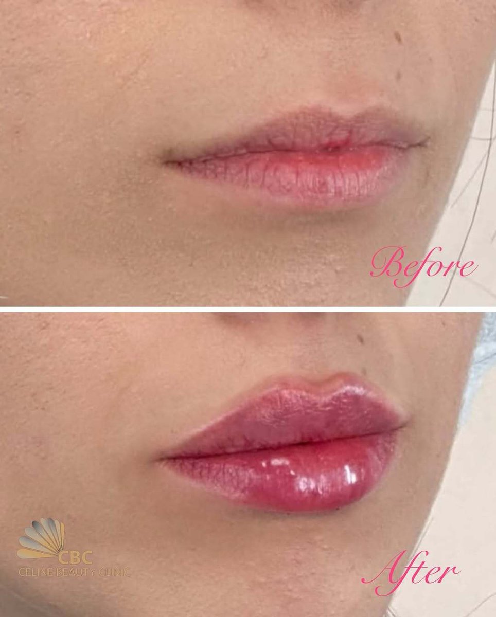 CelineBeautyIr's tweet photo. 💉 فیلر لب = حجم‌دهی طبیعی + فرم جذاب بدون اغراق
تو هم می‌تونی لب‌هایی داشته باشی که همیشه دلت می‌خواست😍

📍مشاوره تخصصی رایگان
📩 دایرکت بده یا تماس بگیر برای رزرو وقت
📞 021-44115040

تهران ، فردوس غرب📍

#فیلرلب#کلینیک_سلین#کلینیک_زیبایی_غرب#فیلرلب_غرب#ژل_لب#فیلرلب_غرب https://t.co/pIWZZSsg3b