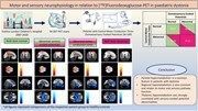 braincomms's tweet image. Tsagkaris, McClelland et al. report that in paediatric dystonia, regional patterns of brain glucose metabolism, measured with PET imaging, are related to neurophysiological measures of the functional integrity of motor and sensory neural pathways. 👉 buff.ly/2vnTZLR