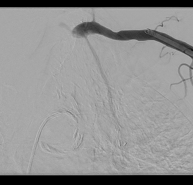 Elderly male, Severe ischemic CM, native LAD occluded, recurrent admissions with NSTEMI/CHF. How would you manage?