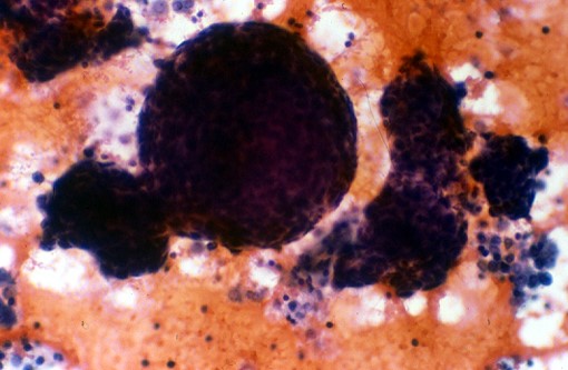 Cannonballs: ductal carcinoma of the breast in a pleural effusion. "When cells read the book and follow the rules..." 😀💦🔬📚#cytopath <a href="/IACytology/">International Academy Cytology</a> <a href="/EfcsYoung/">Young EFCS</a>