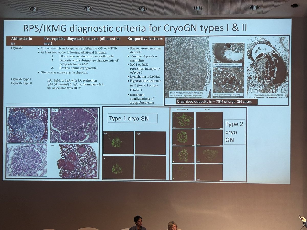 Update diagnostic criteria for Cryoglobulin GN type 1&amp;2, no longer need the presence of serum cryoglobulin. <a href="/onconephsociety/">American Society of Onconephrology</a>