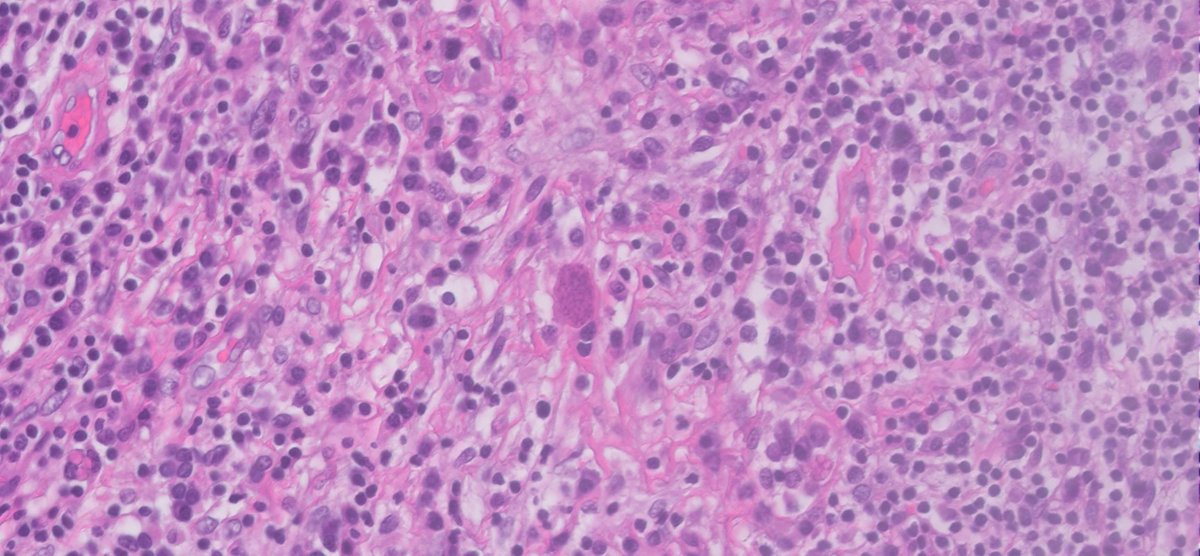 IsraaPath's tweet photo. Cerebral toxoplasmosis: opportunistic CNS infection by Toxoplasma gondii, often in immunocompromised pts.

Path: multiple necrotizing abscesses with central coagulative necrosis, foamy macrophages, and reactive gliosis. H&E: tachyzoites & bradyzoite cysts; IHC highlights organisms.

#Neuropathology #PathTwitter #InfectiousDiseases