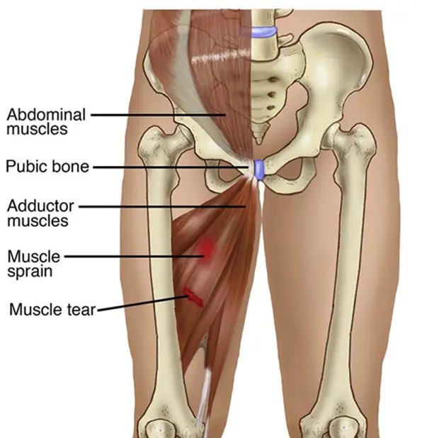Ever wondered what’s the difference between a muscle sprain and a muscle tear?  Here is the difference

Sprain = overstretched fibers (painful but intact)
Tear = fibers actually rip (longer recovery)

Your body feels the difference! 
#sportstips #athlete #Comey #RyderCup #Henley
