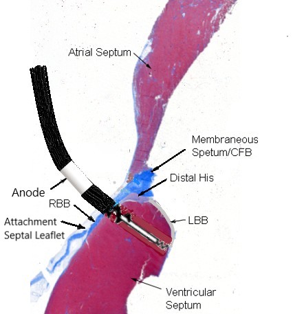 PacemakerPatientAdvo tweet media