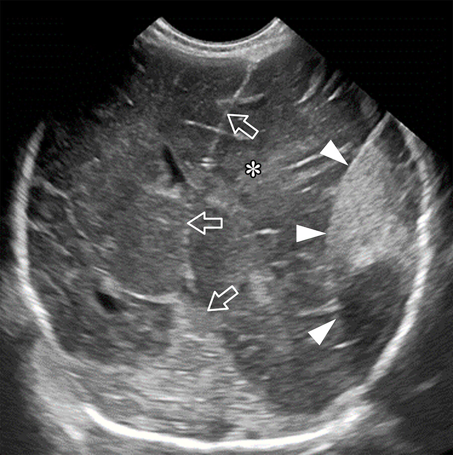 Not every bright spot at neonatal head US is bad news. Some are normal variants, others signal disease. Location + age hold the clues. bit.ly/4np69V6