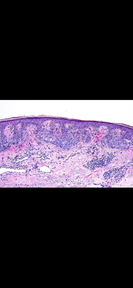 JMGardnerMD's tweet image. 80 yo man with slowly growing brown patch on cheek. Your diagnosis?
Bonus point: what is the WRONG diagnosis?
Answer ✅ youtu.be/FQomxOwuIbQ?si…
#pathology #pathologists #pathTwitter #dermpath #dermatology #dermatologia #dermtwitter