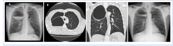 🫁 Publicado en la Revista de Patología Respiratoria
“Bulla pulmonar gigante sobreinfectada: evolución favorable con antibioterapia” RPR 2025;28(3):178-179

👏 ¡Enhorabuena a nuestra residente María Conejero por este excelente trabajo!
🔗 doi.org/10.24875/RPR.2…
#bulla