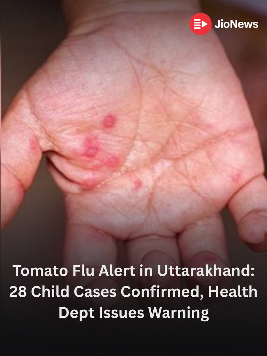 JioNews's tweet image. The Uttarakhand Health Department has sounded an alert after confirming 28 cases of “Tomato Flu” — medically known as Hand, Foot, and Mouth Disease (HFMD) — among children, primarily from Sitarganj.
The viral infection is characterized by fever, skin rashes, and painful…