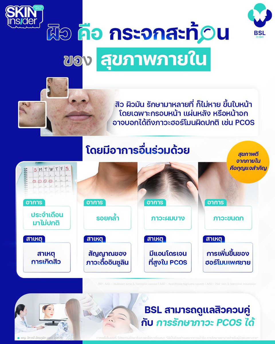BSLBANGKOK's tweet image. ผิวไม่ได้บอกแค่ความสวย… แต่สะท้อนสุขภาพภายใน 🌿

✔️ สิวไม่หาย → ฮอร์โมนไม่สมดุล (PCOS)
✔️ ผิวคล้ำ/หนา คอ-รักแร้ → สัญญาณดื้อต่ออินซูลิน
✔️ ผมร่วง+ขนดก → แอนโดรเจนสูง

ปรึกษาผิวที่
Line: @bslclinic 
โทร: 099-343-8666

#BSLClinic #PCOS #ผิวสะท้อนสุขภาพ #รักษาสิว