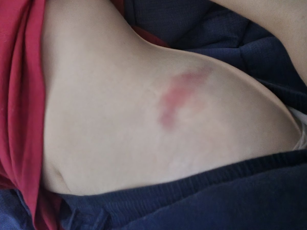 The cruel part of losing weight is there's been more friction and bruise on my hip/hip bone because I have no more fat to protect that area anymore. The bruise is way too big