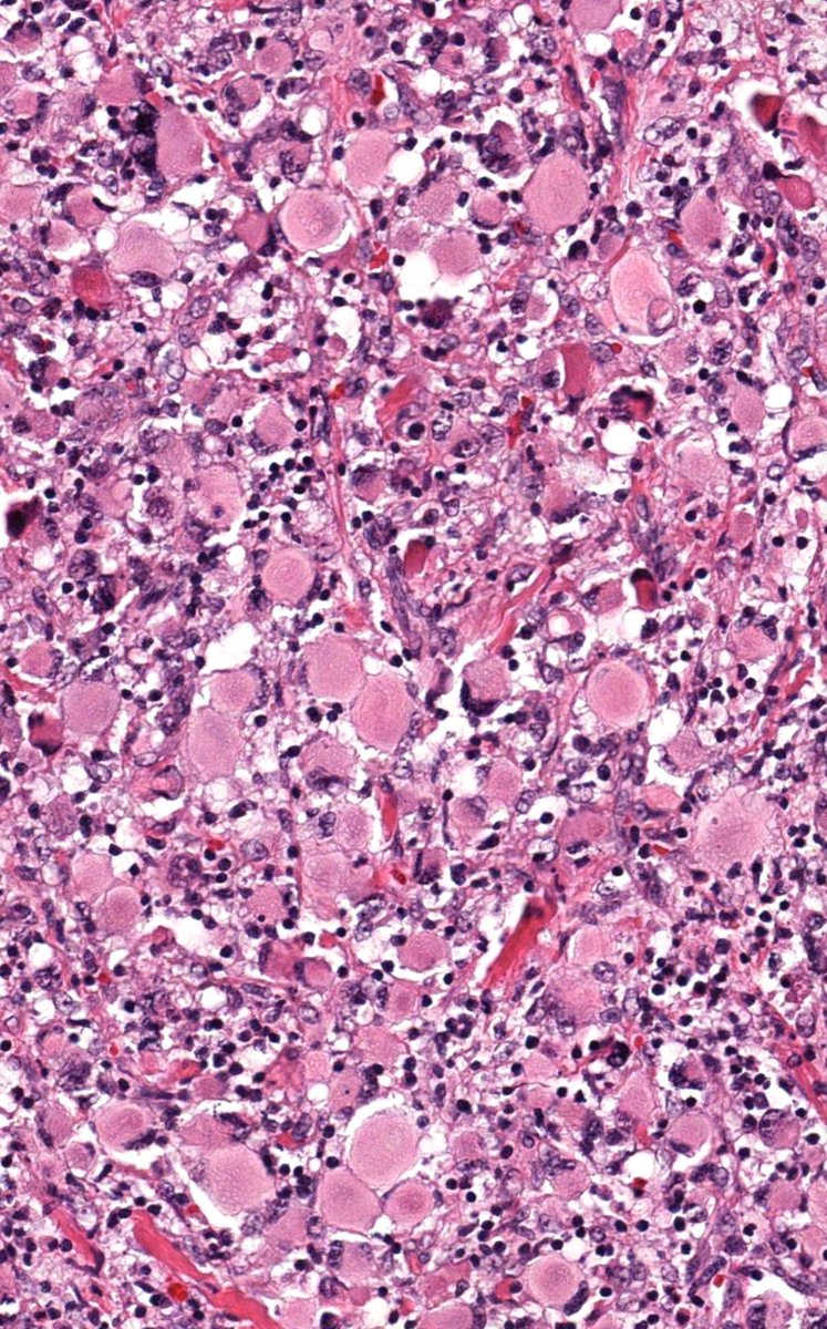 JMGardnerMD's tweet image. Adult subQ nodule. Desmin negative.
Answer ✅ youtube.com/watch?v=vKPX9e…
WSI: kikoxp.com/posts/21101
Other cases: kikoxp.com/posts/8152 & kikoxp.com/posts/18028
Ddx: kikoxp.com/posts/18029
#pathology #pathologists #pathTwitter #dermpath #BSTpath