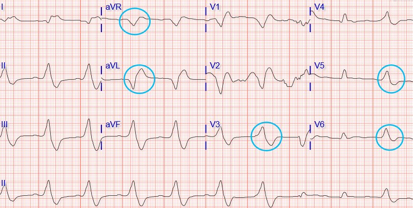 Which of the following is NOT a typical ECG finding in hyperkalemia?
A. Peaked T waves
B. Prolonged PR interval
C. Widening of QRS complex
D. Prominent U waves