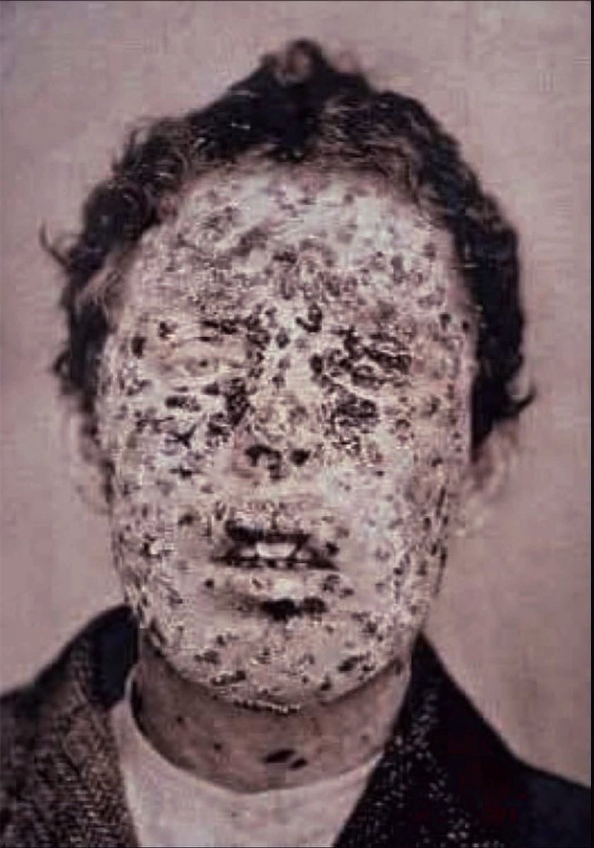 RusslyA's tweet image. منذ 12 ألف عام، كان أشرس وباء تعرفه البشرية هو مرض الجدري، وحشٌ كاسح يلتهم البشر بالملايين، من كل ثلاثة يصيبهم كان يقتلُ واحداً، ما أن يصيب آدمياً حتى يكتسح جلده بالبثور والقروح والجروح، ويتركه  في علةٍ لا تشفى..

مرضٌ ترك بثوره على وجه رمسيس الخامس، وشوه وجه إليزابيث الأولى،…