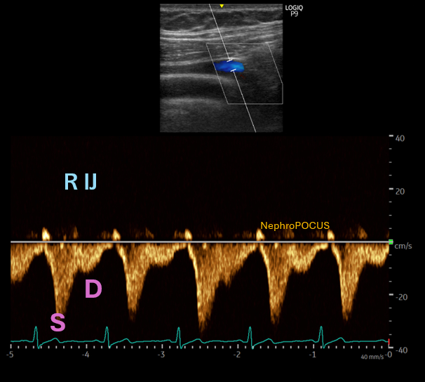 NephroP's tweet photo. 🔴 Since IJV #Doppler is part of #eVExUS, a quick note on that too -> it should, in theory, resemble the hepatic vein waveform. But head position, probe pressure, and where you place the Doppler sample (especially near the collapse point) can all alter the tracing. Getting a “pretty” waveform isn’t always possible. Simultaneous EKG helps.