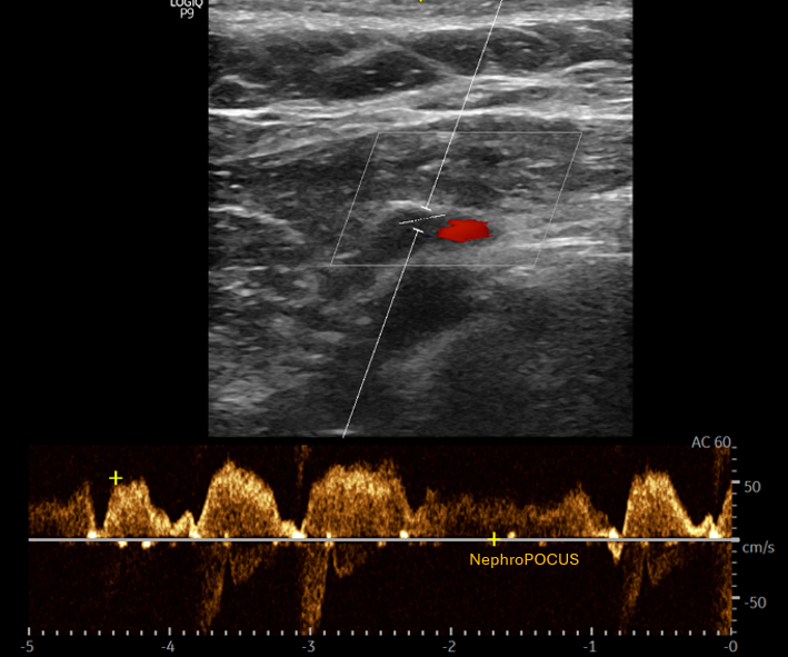 NephroP's tweet photo. 🔴 Since IJV #Doppler is part of #eVExUS, a quick note on that too -> it should, in theory, resemble the hepatic vein waveform. But head position, probe pressure, and where you place the Doppler sample (especially near the collapse point) can all alter the tracing. Getting a “pretty” waveform isn’t always possible. Simultaneous EKG helps.