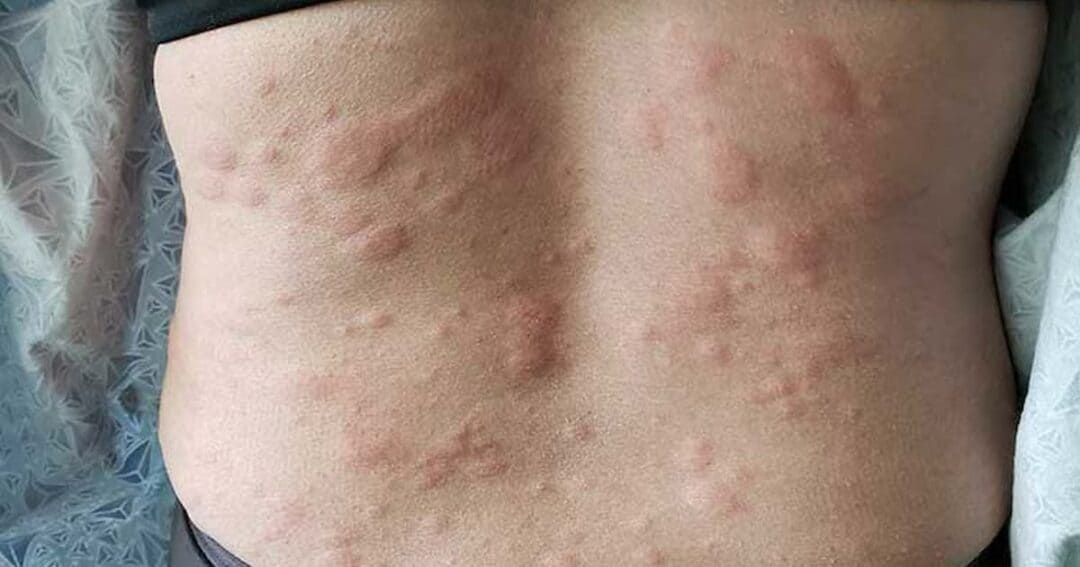 Patient Values and Preferences in #Chronic #Urticaria Treatment:  these systematically synthesized CU-specific values and preferences can be used to improve CU management and clinical practice guidelines. jamanetwork.com/journals/jamad…