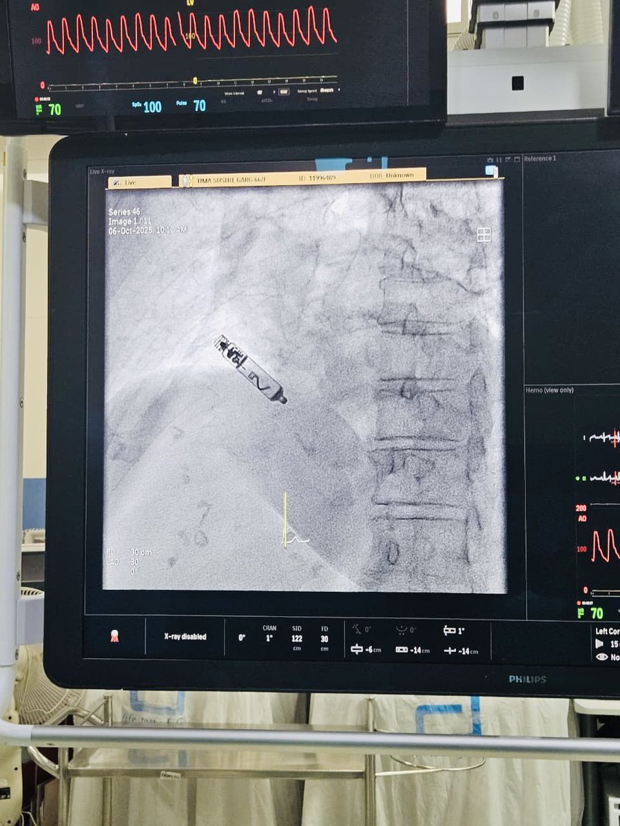 vanitarora's tweet image. Minimally invasive, maximum impact! Successfully performed AVEIR AR Leadless Pacemaker implantation, offering new hope to patients with Sinus Node Dysfunction. #LeadlessPacemaker #CardiacCare #ApolloHospitals
#AveirAR