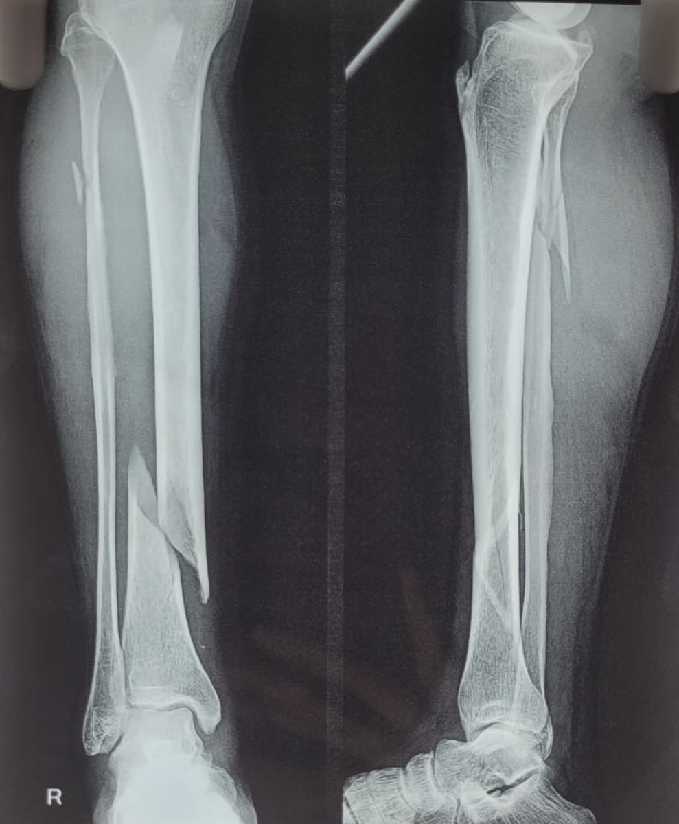 JJIMS_Silchar's tweet image. Biological fixation achieved by @drrajdeeproy and team.

MIPPO ( Minimally Invasive Percutaneous Plate Osteosynthesis ) in a70yr/M.

Benefits :

Micro incision
Early recovery 
Less hosp stay
Early return to work.

@AAOSAdvocacy 
@BritOrthopaedic 
@IOA