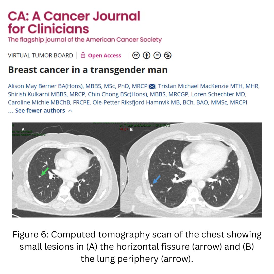 CA: A Cancer Journal for Clinicians (@cacancerjournal) on Twitter photo A multidisciplinary tumor board on #BreastCancer in a transgender man includes the patient perspective. For many TGD individuals, gender‐affirming medical interventions are key to addressing gender incongruence.
🔗: acsjournals.onlinelibrary.wiley.com/doi/full/10.33…
<a href="/OncoAlert/">OncoAlert</a> <a href="/TumorBoardTues/">#TumorBoardTuesday</a> #BCSM A multidisciplinary tumor board on #BreastCancer in a transgender man includes the patient perspective. For many TGD individuals, gender‐affirming medical interventions are key to addressing gender incongruence.
🔗: acsjournals.onlinelibrary.wiley.com/doi/full/10.33…
<a href="/OncoAlert/">OncoAlert</a> <a href="/TumorBoardTues/">#TumorBoardTuesday</a> #BCSM