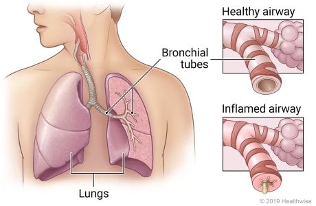 drabdulhameed07's tweet image. A 65-year-old chronic smoker has chronic cough, sputum production, and exertional dyspnea. 
PFT shows ↓FEV1/FVC ratio.

🔍 Most probable diagnosis?

🔴A) Asthma

🔴B) Chronic bronchitis

🔴C) Pulmonary fibrosis

🔴D) Emphysema

#MedX #MedTwitter #cough
