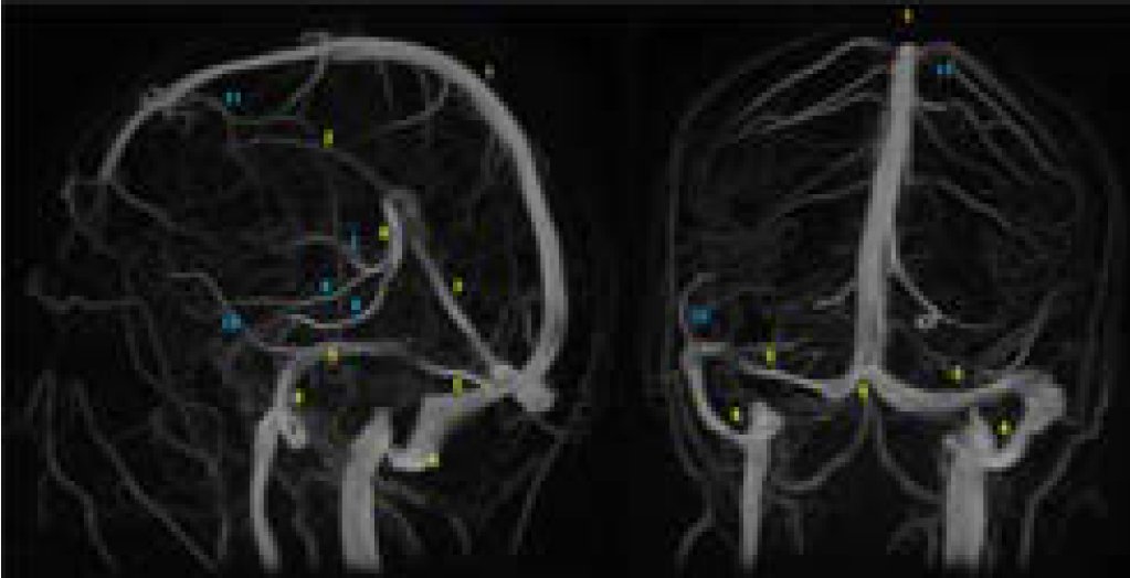 ASNRographics's tweet photo. From the July-September 2025 Issue of #Neurographics: Cerebral Venous Thrombosis: Practical Tips for Radiology Trainees https://t.co/P12fRgeBPj https://t.co/8fKgpow0zj
