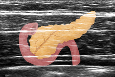 anesthesianews's tweet image. New research finds ultrasound-guided TAP blocks can safely reduce pain, opioid use, and hospital stays for acute pancreatitis patients in the ER. Breathe easy with this groundbreaking treatment! #TAPBlock #PainManagement #MedicalInnovation anesthesiologynews.com/a/zzEBAA/t