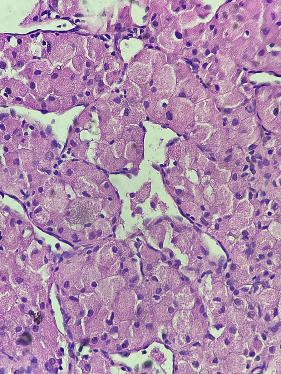 Immanuel_Paul30's tweet photo. 20s/F
Shoulder mass
💭
#PathX #pathology #oncopath #surgicalpath #pathologist #HEpath https://t.co/zkBnDK1oRx