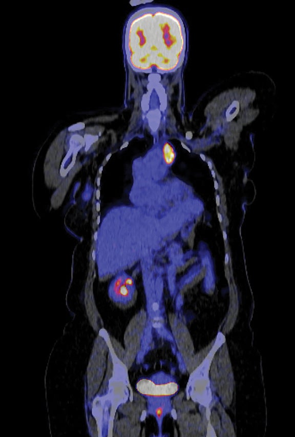 Applied_RadOnc's tweet image. Case Report: Mediastinal Epithelioid Hemangioendothelioma in a Patient With Concurrent Early Stage Right Breast Cancer
💗🔗 ow.ly/88Kj50X8URp
#BCAM25 #BreastCancerAwarenessMonth #WomensHealth #RadOncEd #MedEd