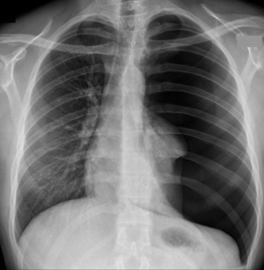 saikenMD's tweet image. Just admitted a healthy early20's guy with no past medical history who presented with sudden chest pain after hitting his vape. CXR looks like the example pic:
What's the diagnosis?