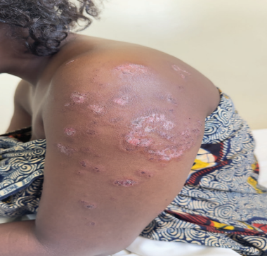 A rare autoimmune puzzle 🧩

A 26-year-old woman diagnosed with both Systemic Lupus Erythematosus (SLE) and Morphea—two distinct but overlapping immune disorders.

This case highlights how complex and intertwined autoimmune diseases can be, demanding early, multidisciplinary
