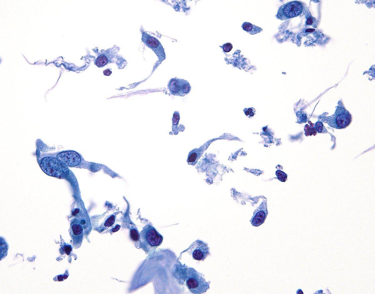 sza_jhcyto's tweet image. &quot;Epithelioid&quot; cells with cytoplasmic tails - The typical differential is between melanoma and urothelial carcinoma. Shown here is a high-grade urothelial carcinoma. (voided urine, ThinPrep)