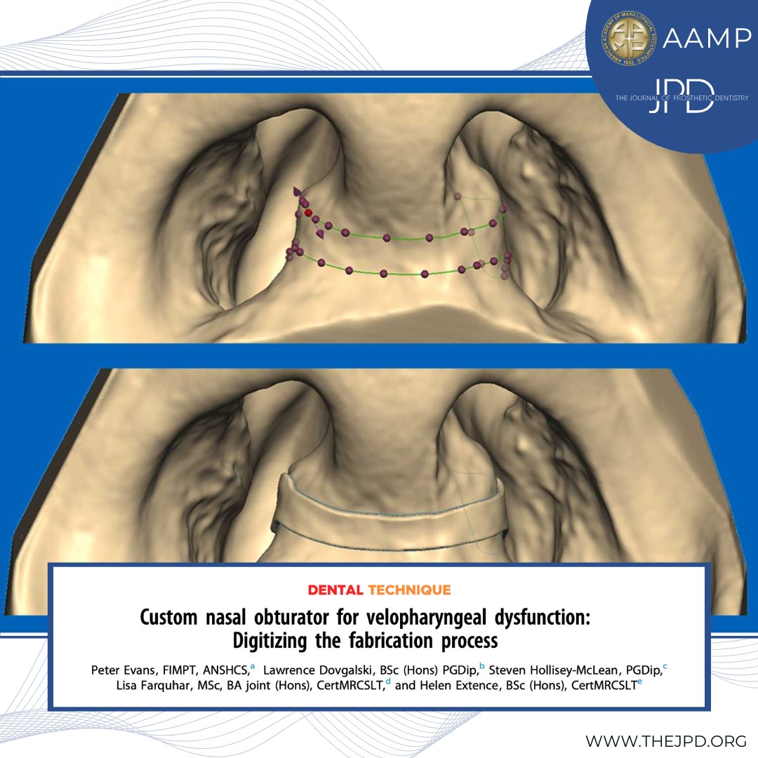 JPDentistry's tweet photo. A nasal #obturator can assist with #velopharyngealdysfunction by controlling airflow. Check out this analog-digital approach, highlighted by #theJPD and #AAMP, for fabricating, designing, and #3dprinting this unique prosthesis: https://t.co/xDw8n1ldih https://t.co/x5LxsUTYBU