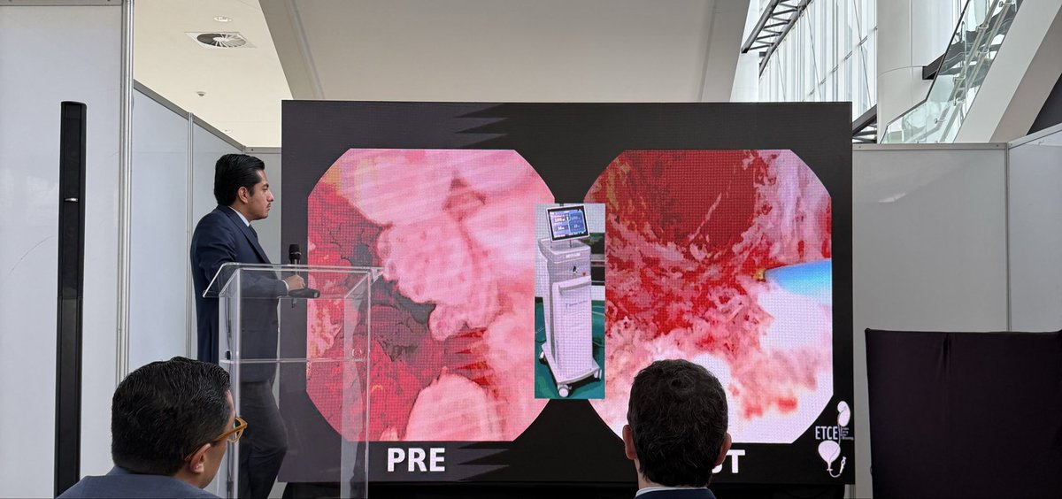 GuidoGiusti's tweet photo. From publication to real life : gr8 video presentation by @axelhernandezmd on conservative treatment of #UTUC by means of #Thulio #pulsedThYag laser #CAU2025 🇵🇦 thanks @DornierMedTech for the continuous support and bravo 👏🏻 Axel! #ETCE https://t.co/cT2zrqP5Xv